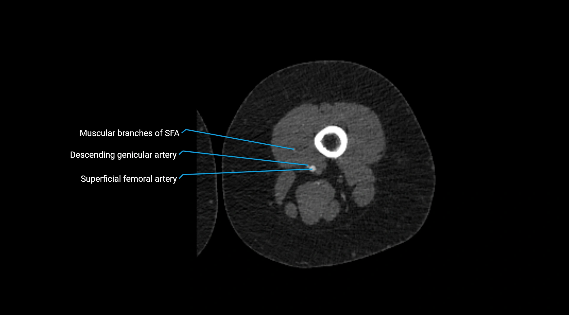 CTA lower limb cross sectional anatomy labelled image _145.webp